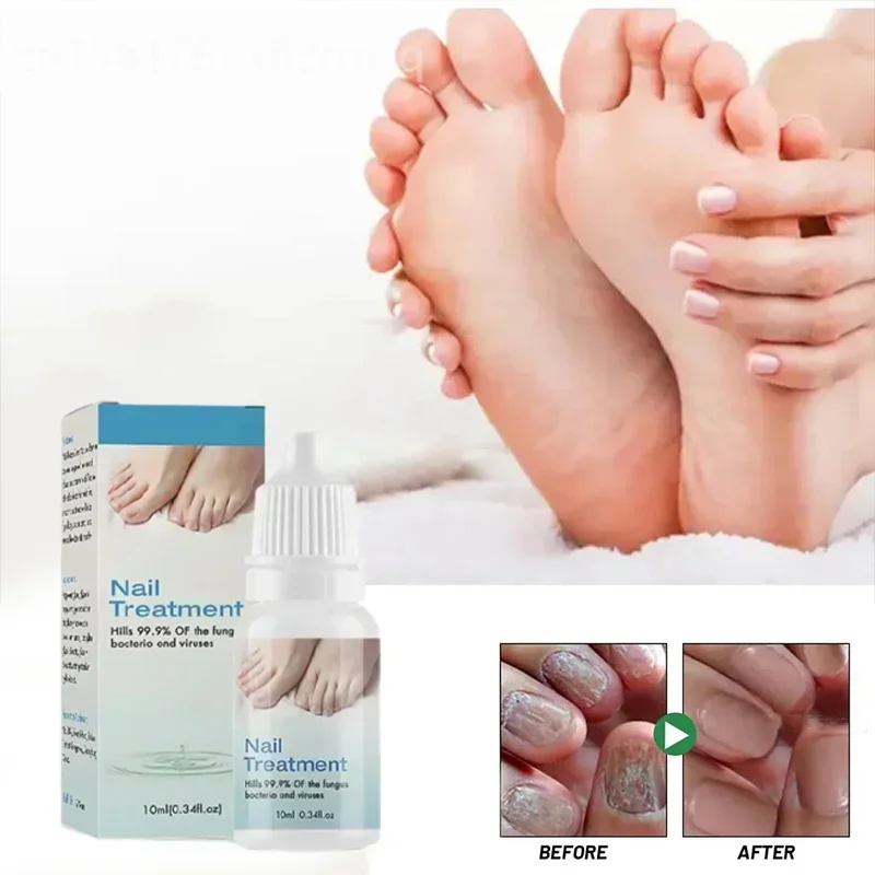 Fungal Nail Treatment Oil Foot Repair Essence Toe Nail Fungus Removal Gel Anti Infection Cream Fungal Nail Removal Paronychia