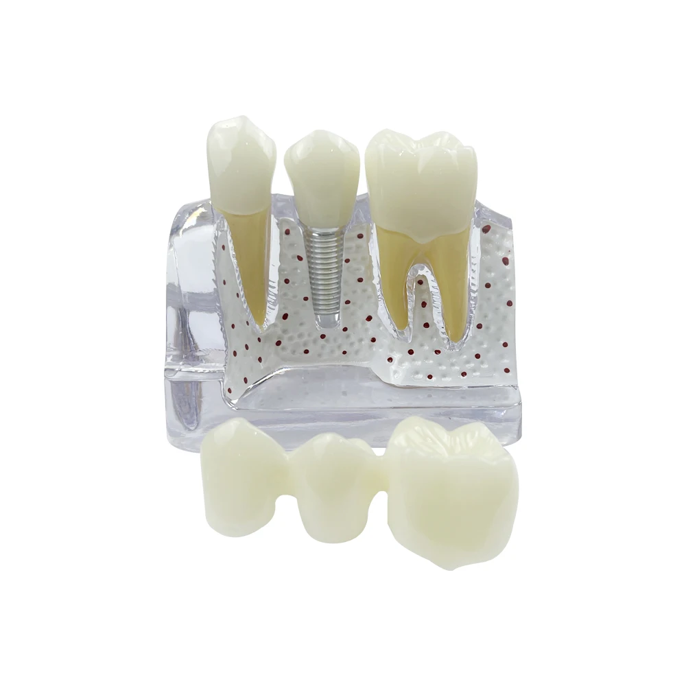 Transparent 4 Times Dental Implant Teeth Model Removable Analysis Crown Bridge Demonstration for Teaching Dentist Study