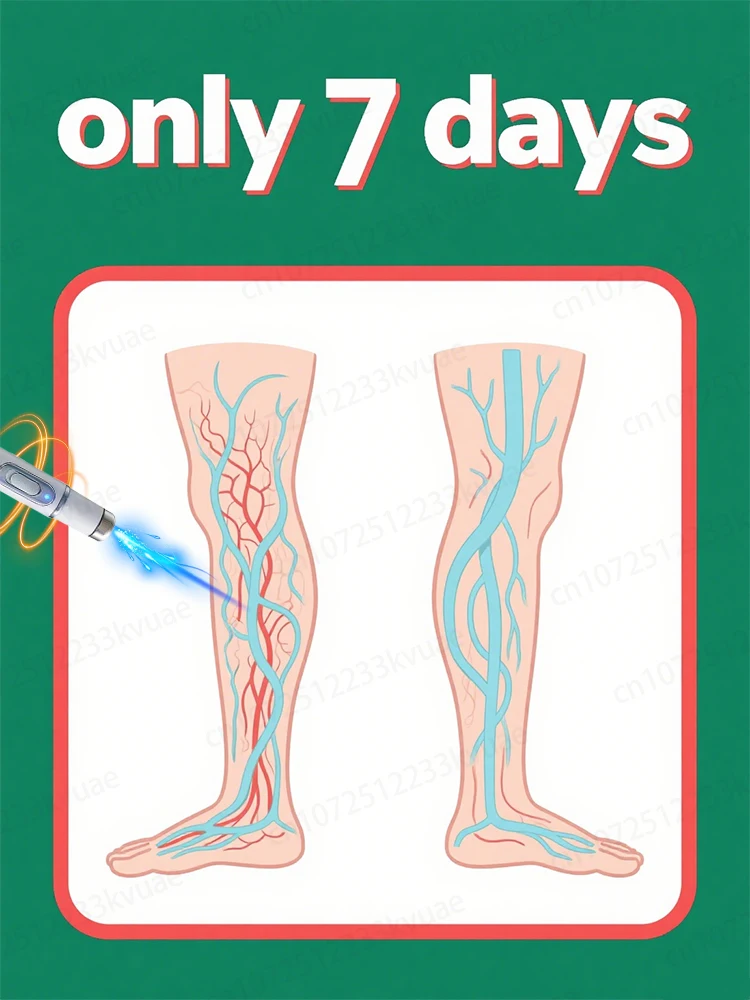 

Generation-8 Laser Says Goodbye To Spider Legs Varicose In 3 Days