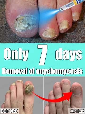 10 best sales फंगस नाखून उपचार - №6