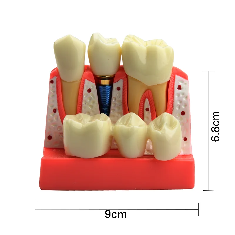 Dental Model Dental Implant Model Denture Bridge Crown Porcelain Restoration Model Dentist Teaching Demonstration Models