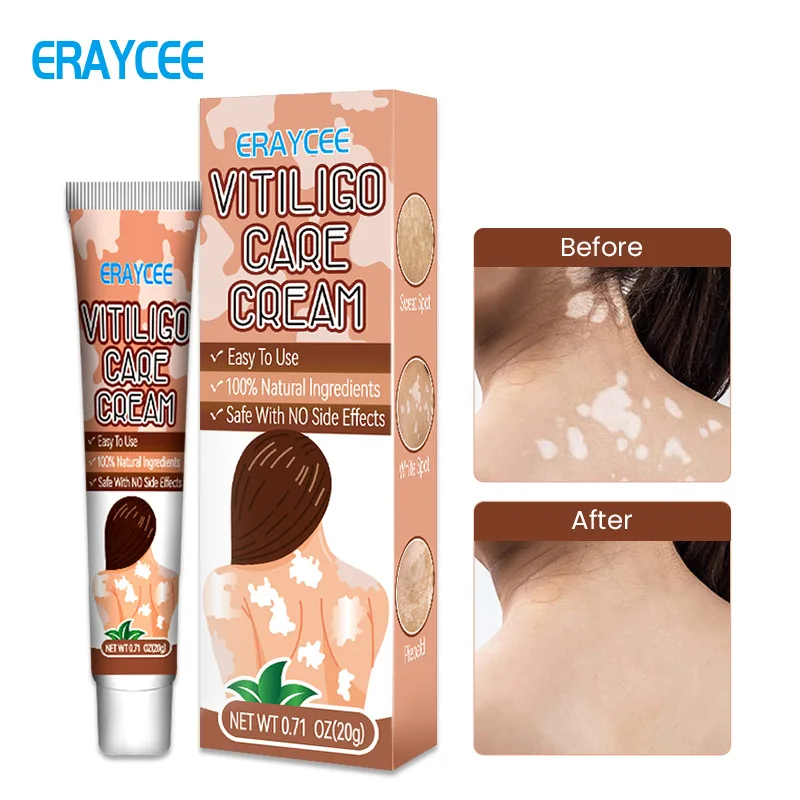 ERAYCEE  Vitiligo Treatment Cream Remove Ringworm White Spot Removal Upgraded