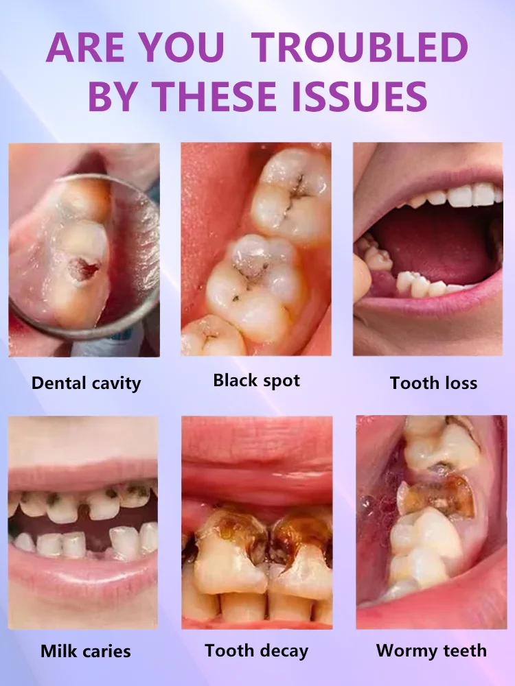 Decay tooth Cavities healing anti caries