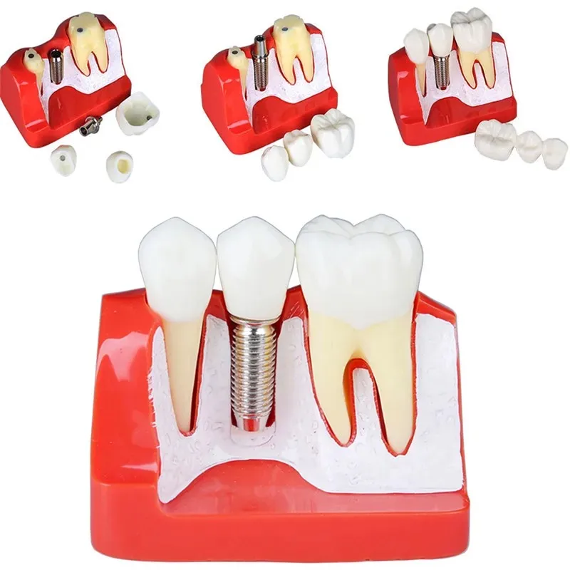 1pcs 4 Times Teeth Model Dental Implant Teeth Implant Analysis Crown Bridge Removable Model Dentist Demonstration Teach Tools