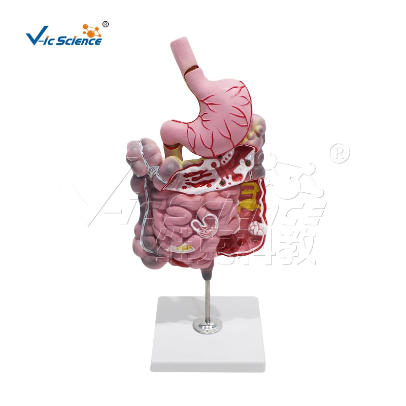 

Digestive system lesion anatomy medical science model