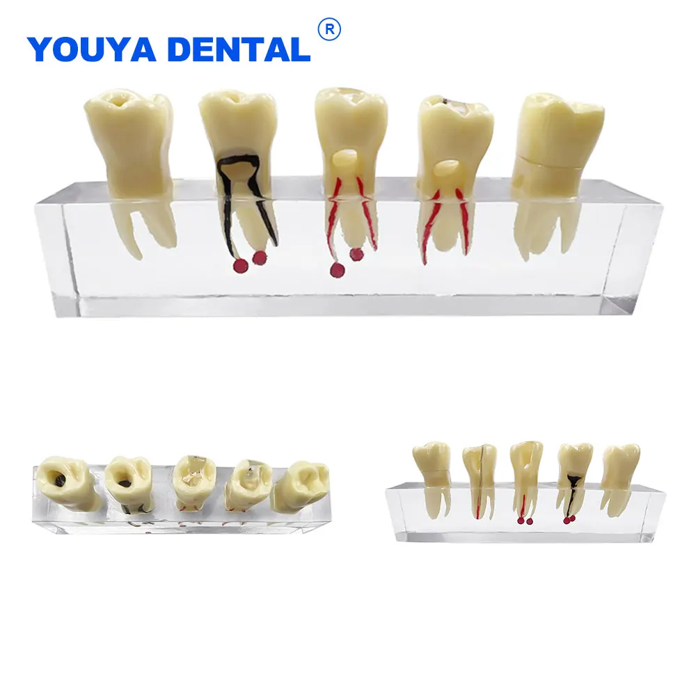 

Teeth Endodontic Dental Pathological Model Education Patient Communication For Studyting Teaching Pathology Dentistry Endo