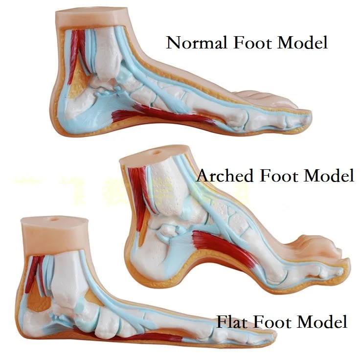 Normal, Flat, Arched Foot Model , Cavus, Foot Joint And Bone Skeleton Massage Foot Model Referance