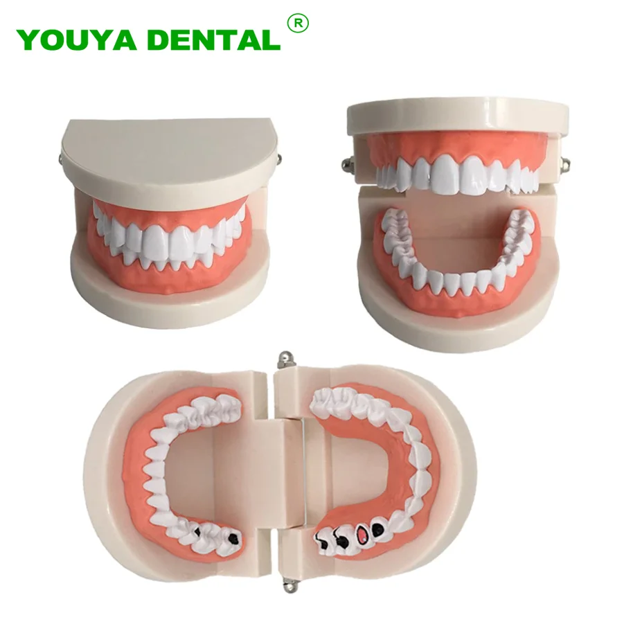 Dental Model Brushing Teeth Education Model Caries Tooth Care Oral Hygiene Studying Teaching Demonstration Dentistry Products