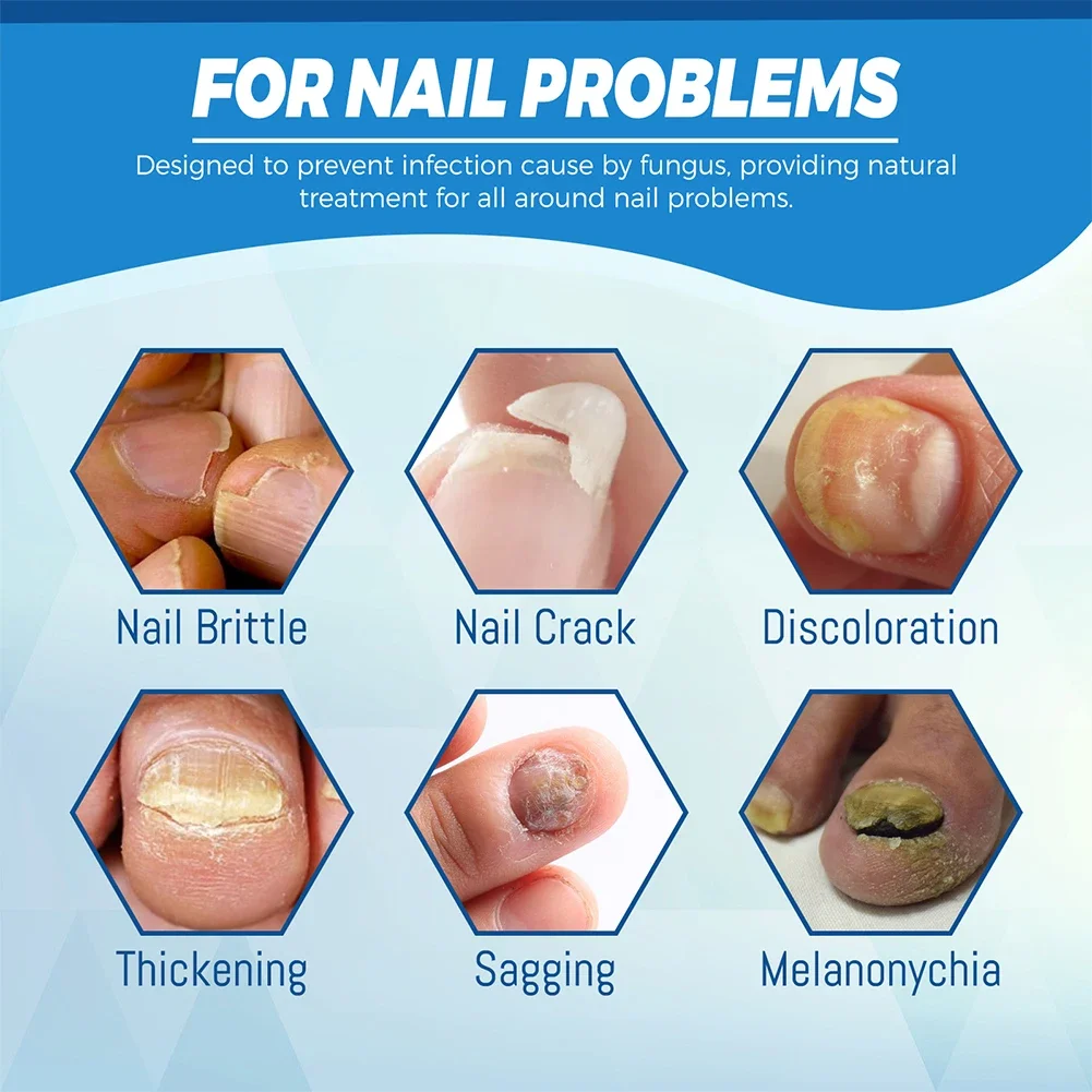 1ชิ้นปากกาการรักษาเชื้อราเล็บป้องกันเชื้อราซ่อมแซมปากกาสีฟ้า pulpen Laser paronychia เล็บ Onychomycosis กำจัดขนไม่เจ็บปวดดูแล