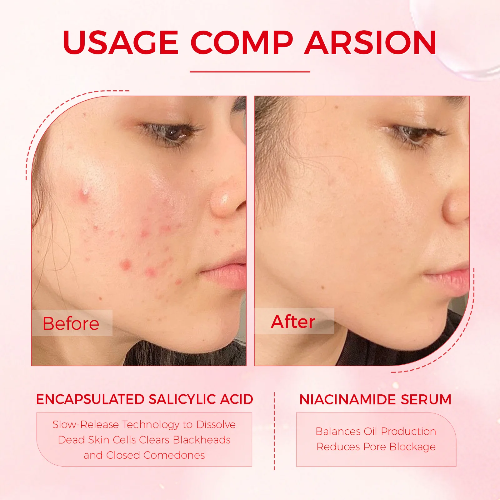 Lozione per l'essiccazione dell'acido salicilico Siero per il viso Trattamento notturno dell'acido dell'acne e delle macchie dell'acne per viso e corpo