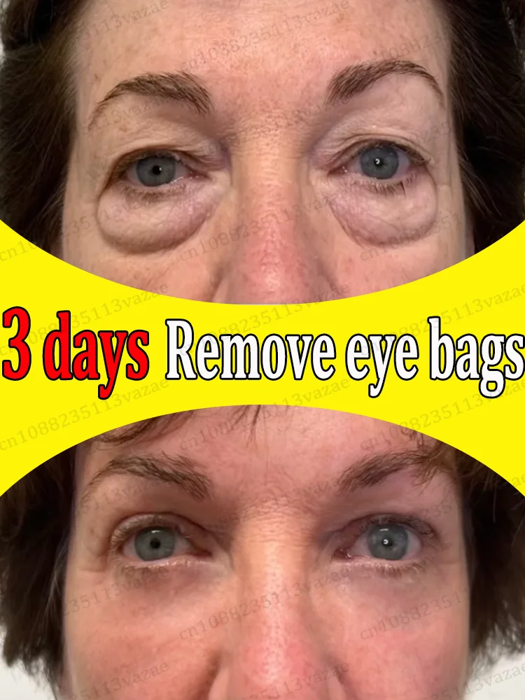 

Verwijder wallen en herstel Jeugdige ogen