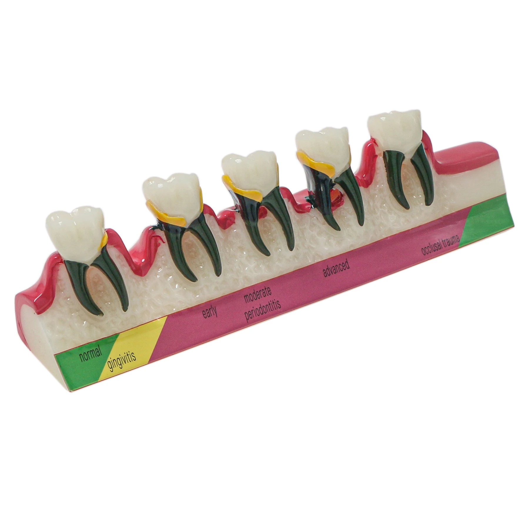 Dental Typodont Teeth Periodontal Disease Model Caries Disease Assort Demo Study Teaching Model for Dental Education M4029