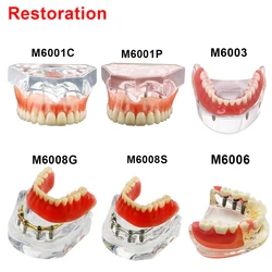 Modelo Dental Restauração Implante Dentes Modelo De Prótese Dentária Para Dentista Paciente Comunicação Tratamento Estudo Demonstração