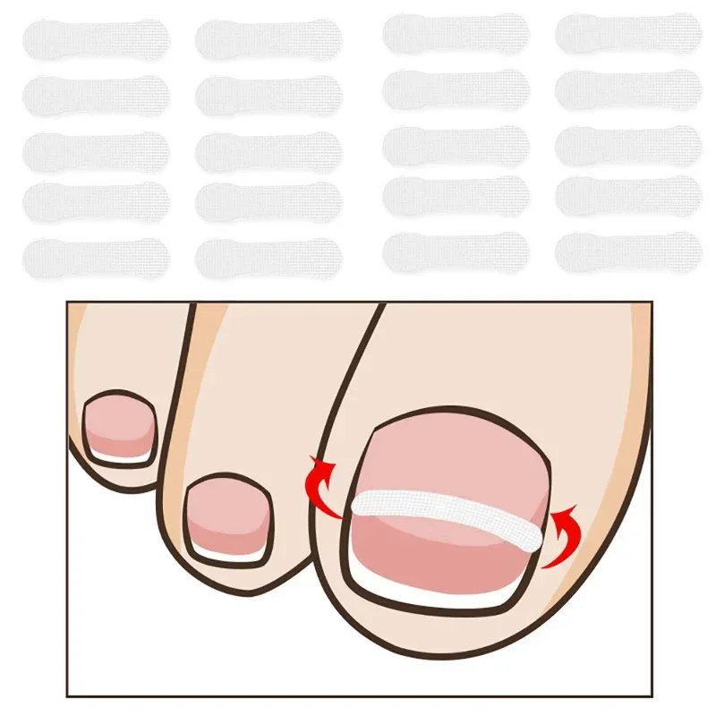 10Pcs Ingrown Toe Nail Treatment Ingrown Toenail Correction Tool Elastic Patch Sticker Straightening Clip Brace Pedicure Tools