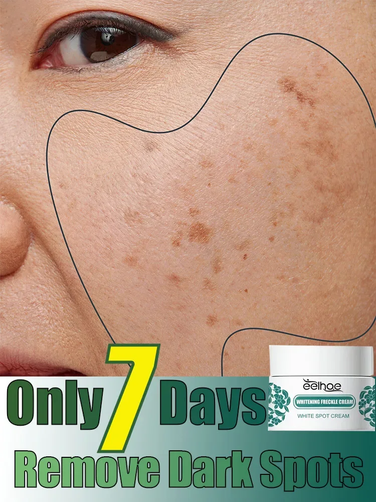 

Effective Whitening Freckles Cream Remove Melasma Dark Spots Fade Pigmentation Moisturize Brighten Face Korean Skin Care Product