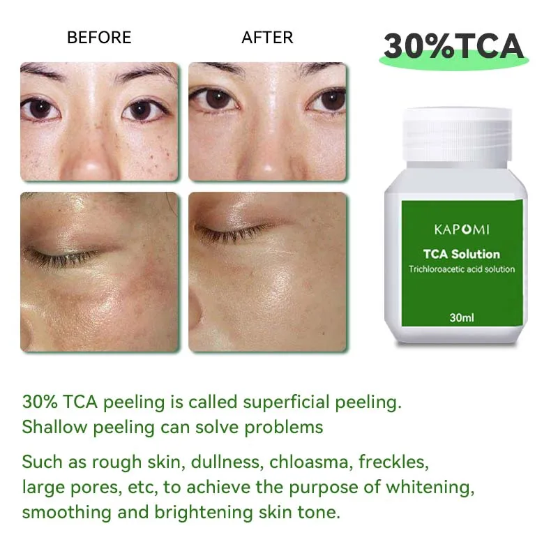 30% 50% 70% Acne Scars Peeling Fluid Professional Grade Acid Peeling Whitening Rejuvenation Skincare