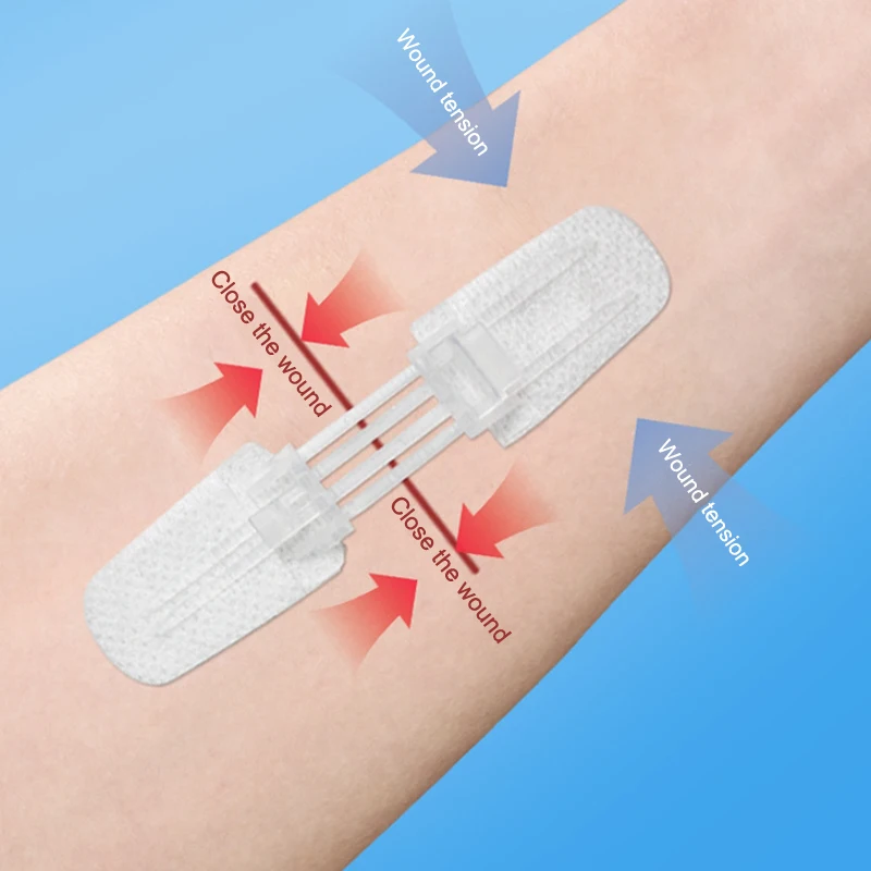 Zipper Band Aid Painless Wound Closure Patch Suture Free Medical Plaster Hospital Nursing Dressing for Surgical Recovery