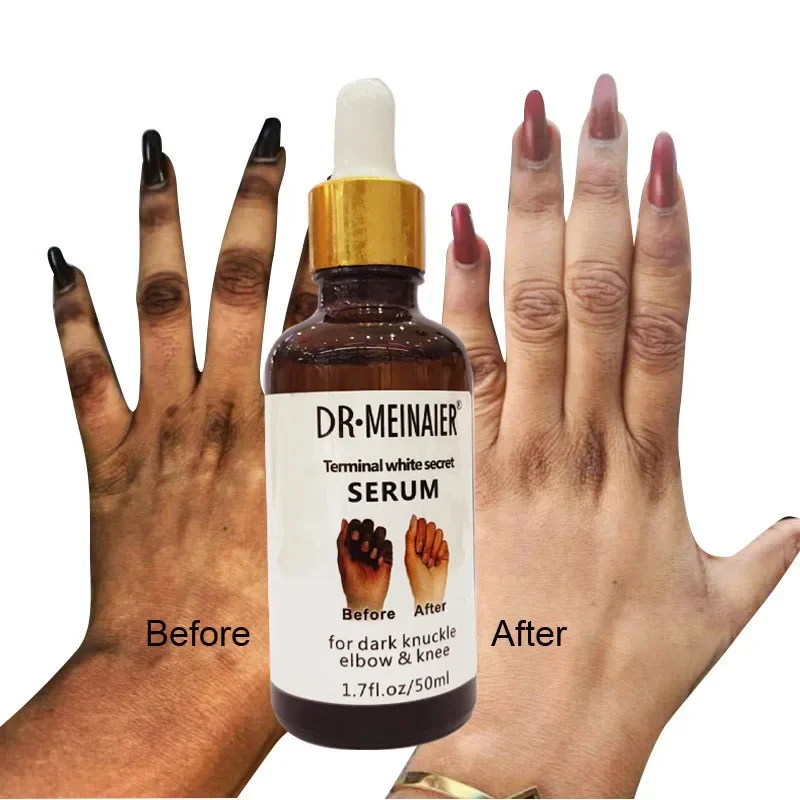 

Get Rid of Dark Knuckles In 7 Days Serum Whitening Knuckle Removal Oil for Cleanser Dark Spots ; Elbows Pigmentation Correctors