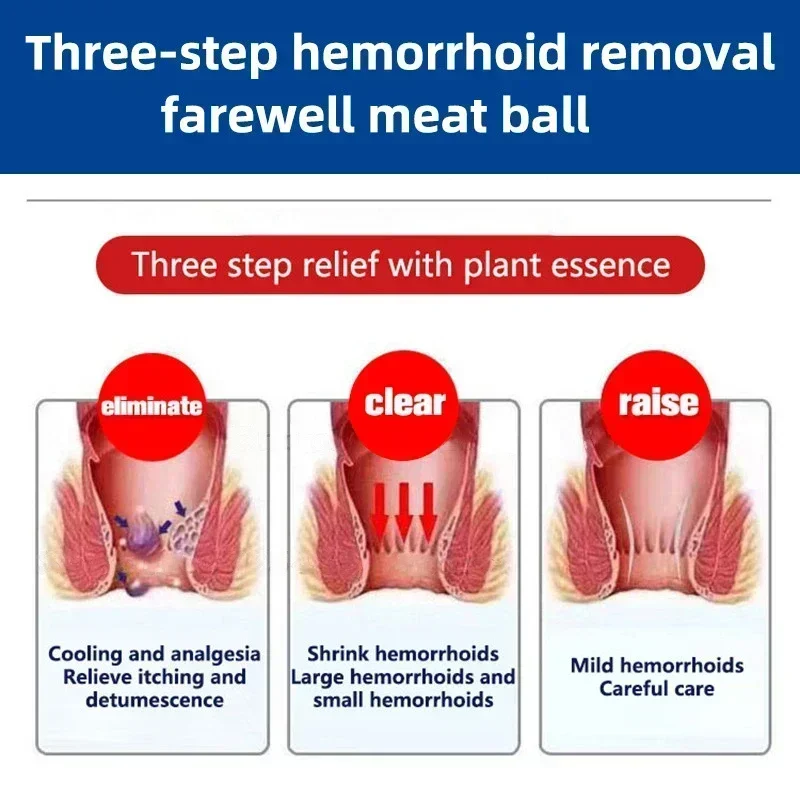 Hua Tuo 강력한 치질 연고, 천연 물질 살균 크림, 내부 치질 더미, 외부 균열 치료