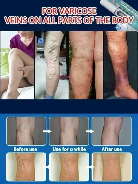 Laser vein | Reduces Spider Veins and Heaviness | Varicose vein laser pointer