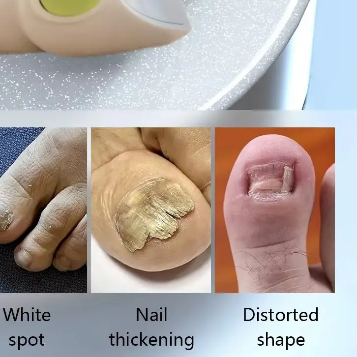 

Medical Grade Nail Fungus Treatment Laser Device, 905nm/470nm Dual-Wavelength, Professional Onychomycosis Therapy for Home