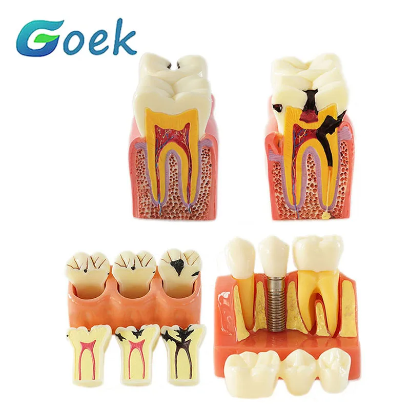 

1Set Dental Teaching Model 4/6 Times Caries Disassembling Comparations Implant Resources Dentistry Laboratory Tool