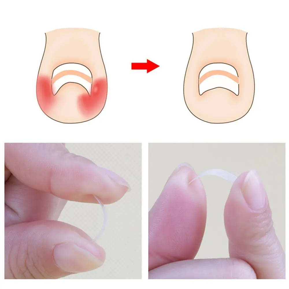 PARON-Outil de pédicure pour ongles incarnés, pince à redresser, attelle Bs incurvée, outil de paronyamitié optique, 10 pièces par bouteille