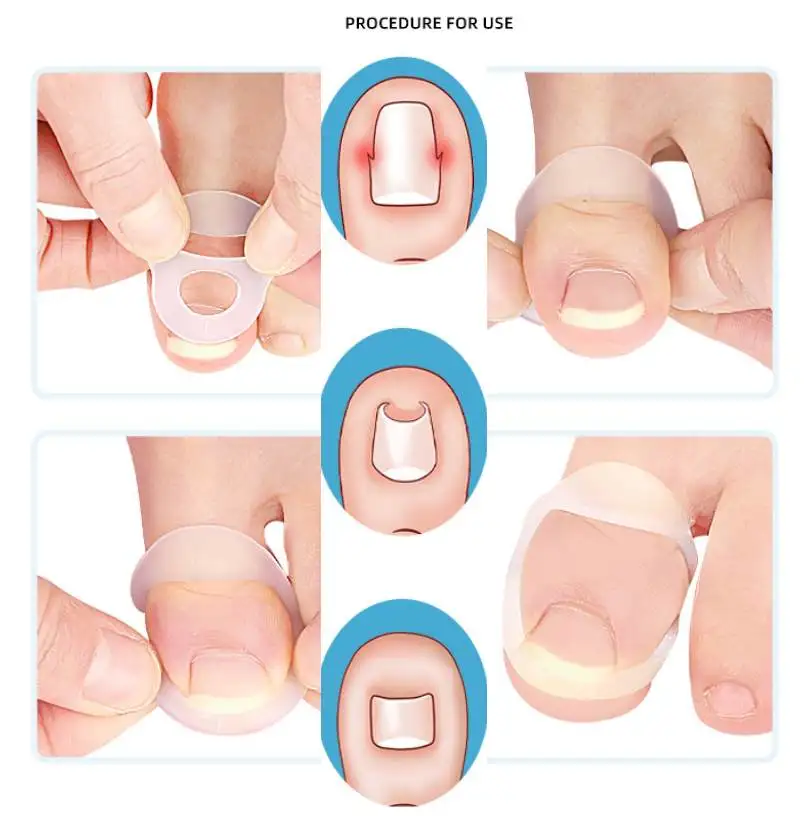 

1/100Pcs Silicone Ingrown Toenail Correction Invisible Ingrown Toe Nail Treatment Elastic Straightening Clip Brace Foot Pedicure