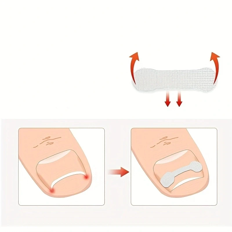 1 scatola Nail Patch Nail Groove Inlay Corrector per la riparazione rapida dell'unghia del piede striscia adesiva