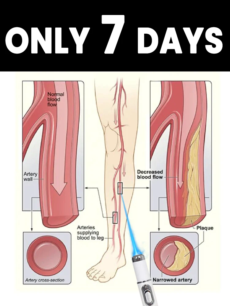 

Handheld blue light device: Improve leg comfort and circulation in 7 days