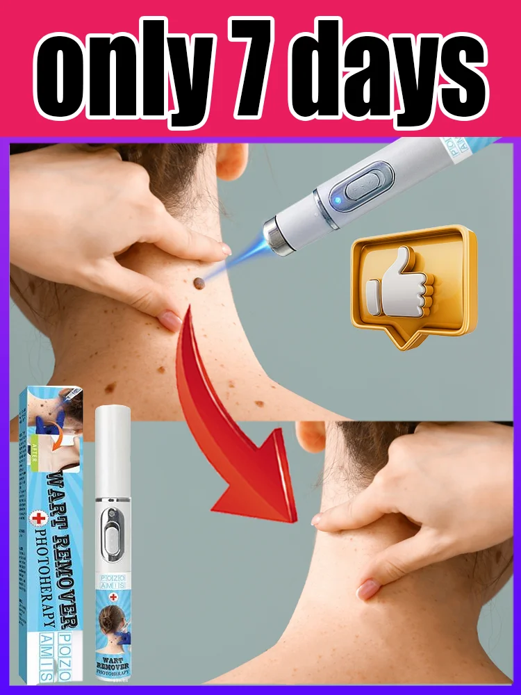 

third generation Blue Light Pen: Effective for Body Wart Removal