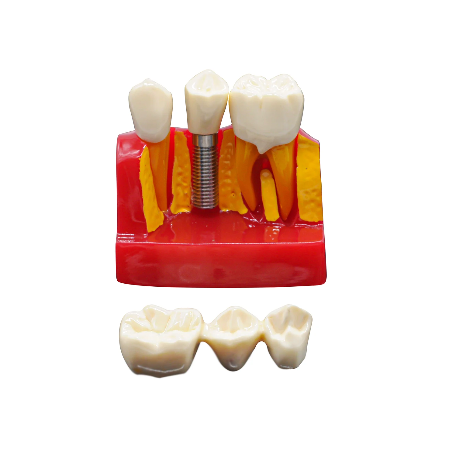 Dental Implant Analysis Model Crown Bridge 4 Times Implant Demonstration Removable Dentist Lab Teaching Models Tools