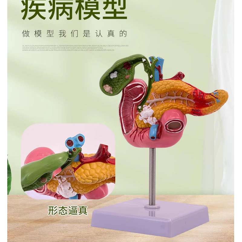 Medical pathological model of pancreas, duodenum and gallbladder hepatobiliary model of cholelithiasis surgical system