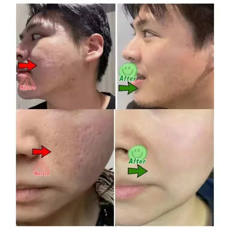 모공 수축 크림 제거 큰 모공 블랙헤드 여드름 구덩이 수리 젤 제거 얼굴 부드러운 피부 한국 케어 제품