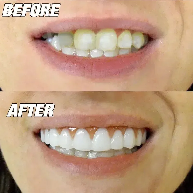 Dente falso temporário sorridente descartável, dentes falsos confortáveis com cola de enchimento, folheados superior e inferior, maquiagem para dentes