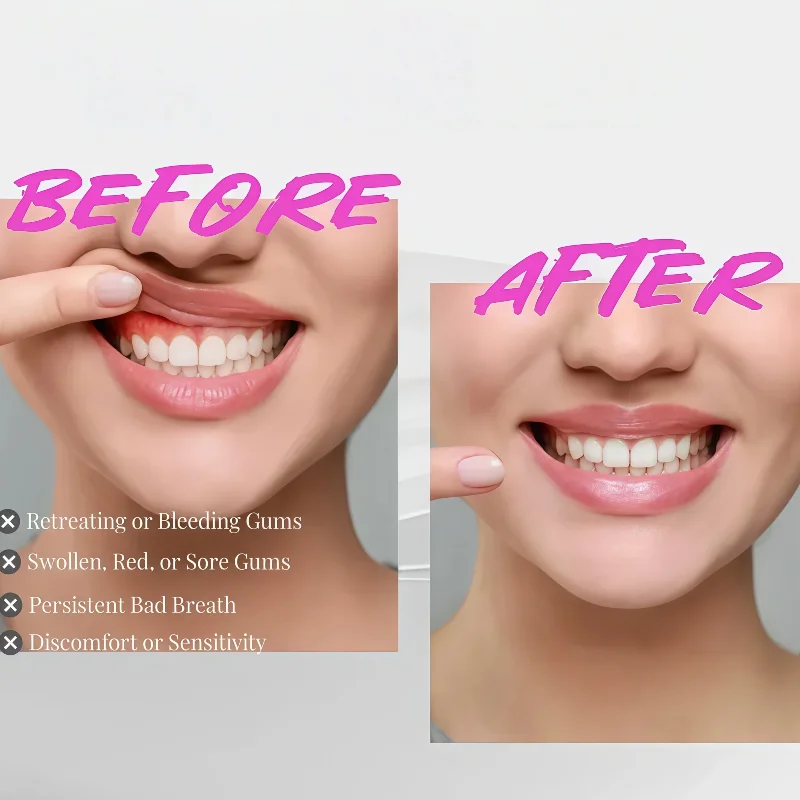 

Starlite Smile Gum Disease Treatment Device - Periodontal Care Red Light Therapy for Oral Healing & Pain Relief