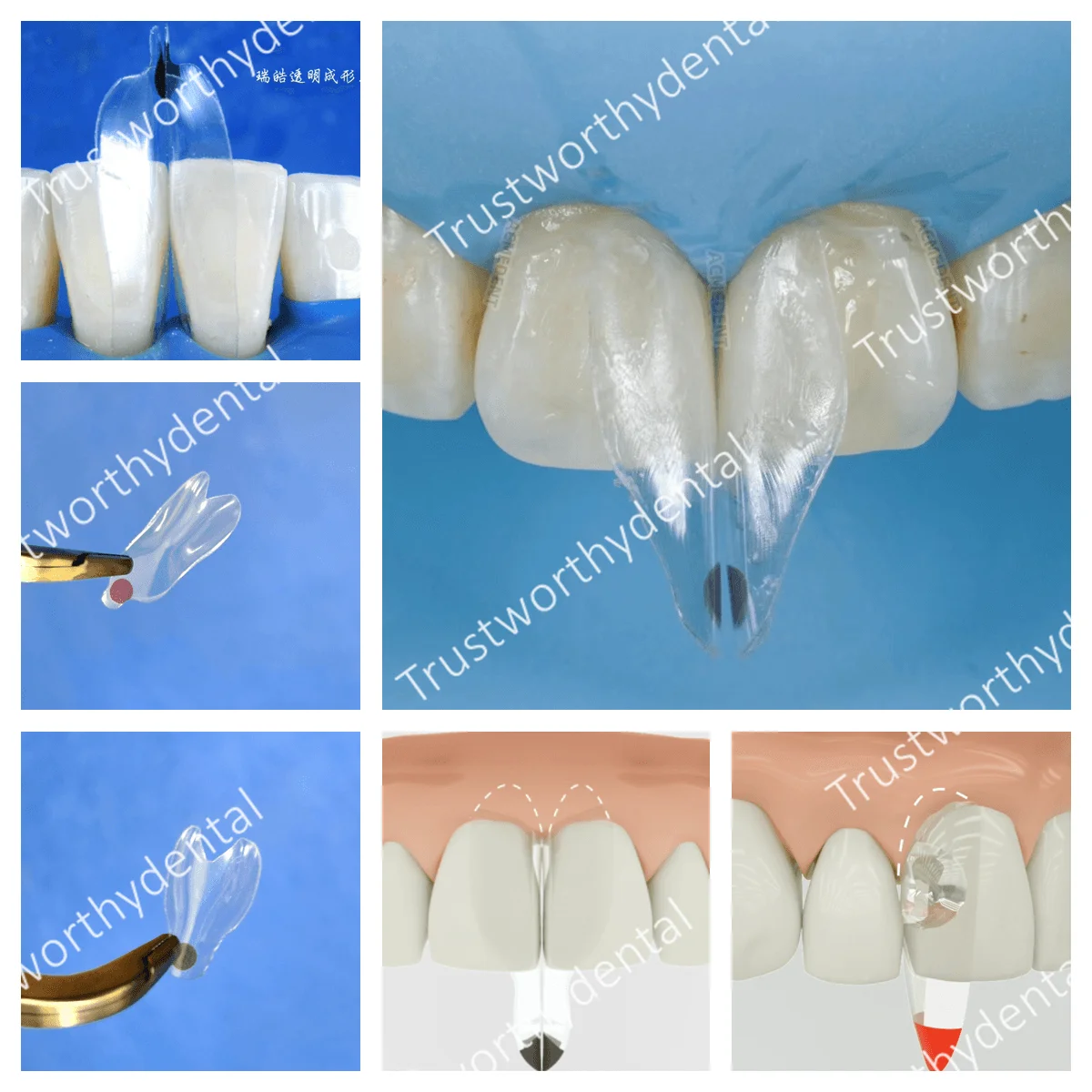 Dental Clear Matrix Bands Transparent Matrices Anterior Front Teeth Composite Diastema Black Triangle Restoration Fits Bioclear