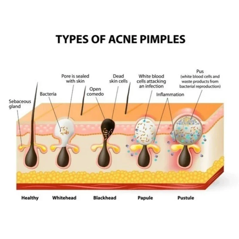 Nose Blackhead Remover Mask Pore Cleaner Acne Treatment Mask Deep Nose Pore Cleasing Strips Black Head Remover Tool