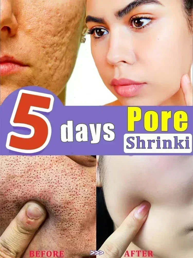 Acidez Poro Encolher Soro Rosto, Remover Cravos, Acne, Controle de Óleo, Reparação Essência, Hidratante, Nutrir Poros Refirmando, Cuidado Facial