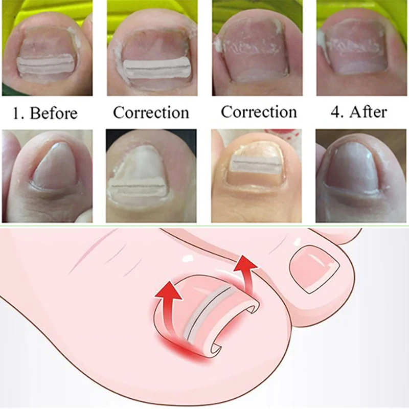 Ingegroeide teennagel Correctie Tool Rechttrekken Clip Brace Ingegroeide teen Nagelbehandeling Elastische patch Sticker Pedicure Tool