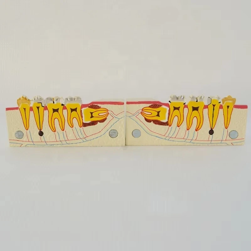 Рисунок 2 - Правый нижний буккальный зуб и корне кариес