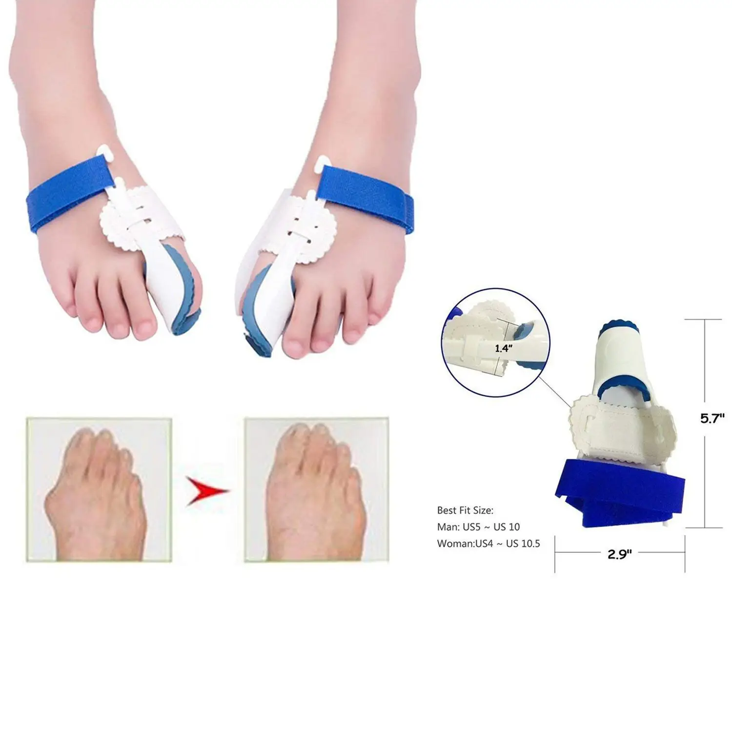 Bunion Corrector and Bunion Relief Kit - Cure Pain in Big Toe Joint,Tailors Bunion, Hallux Valgus,Hammer Toe, Toe Separators