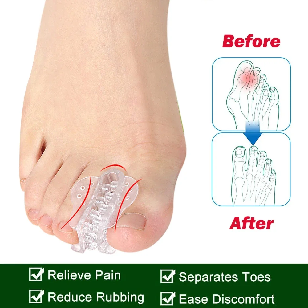 1Pair Toe Separators for Overlapping Toes, Bunions, Big Toe Alignment, Corrector and Spacer