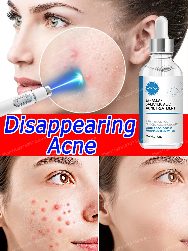 

Acne Cream Remedy Anti Pimple Marks Serum