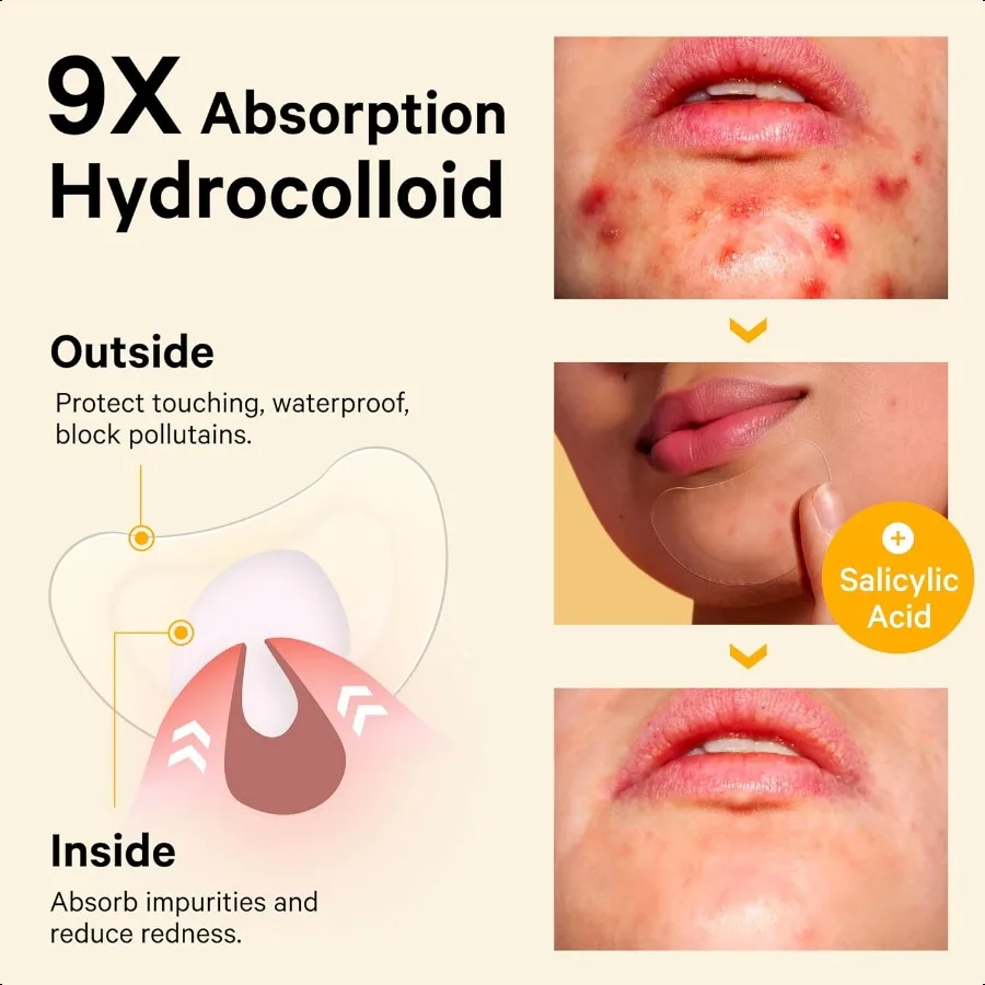 Plasterki na pryszcze na podbródku, hydrokoloidowe plasterki na trądzik na wypryski, duże plamy, kontrola wyprysków, zakrywają twarz, podbródek i ciało, z drzewem herbacianym i kalantrium.
