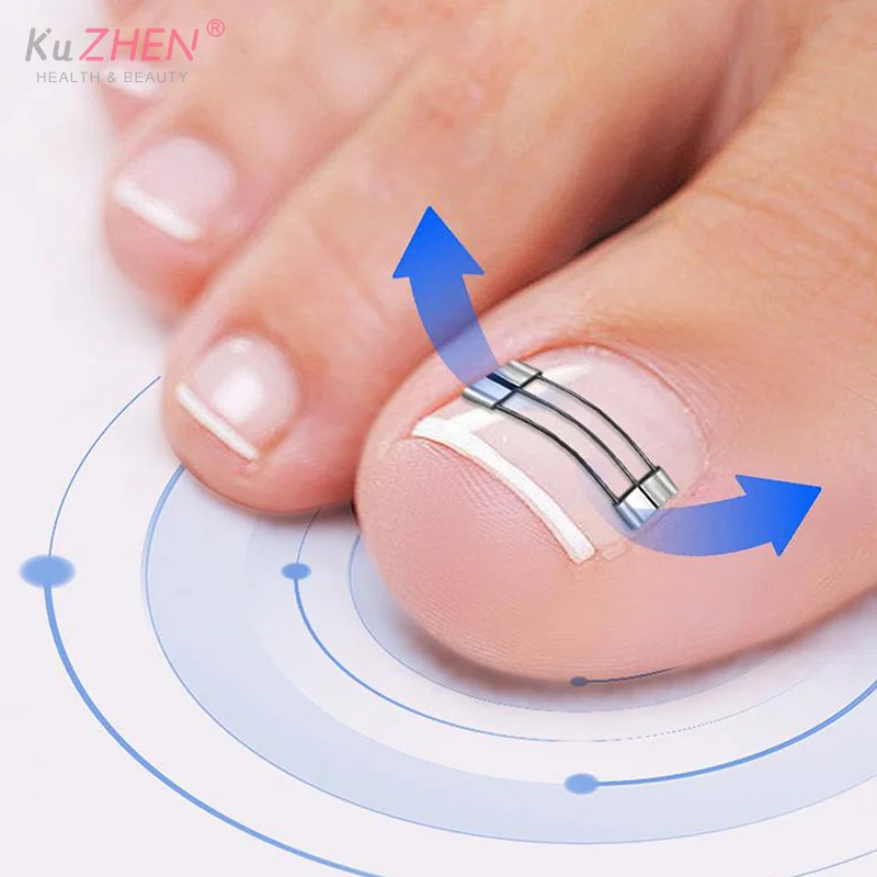 1세트 내향성 발톱 교정 클립 보조 도구 페디큐어 회복 내장형 발톱 치료 전문가용 내향성 발톱 교정기