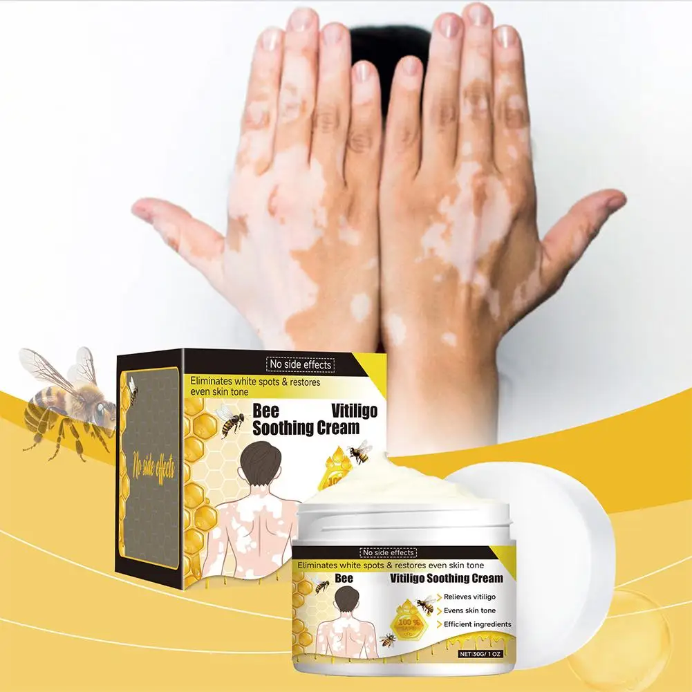 30gBee Vitiligo Treatment Cream Natural Relief Eliminate Pigment White Soothing Spot Treatment Skin Vitiligo Removal L3U0