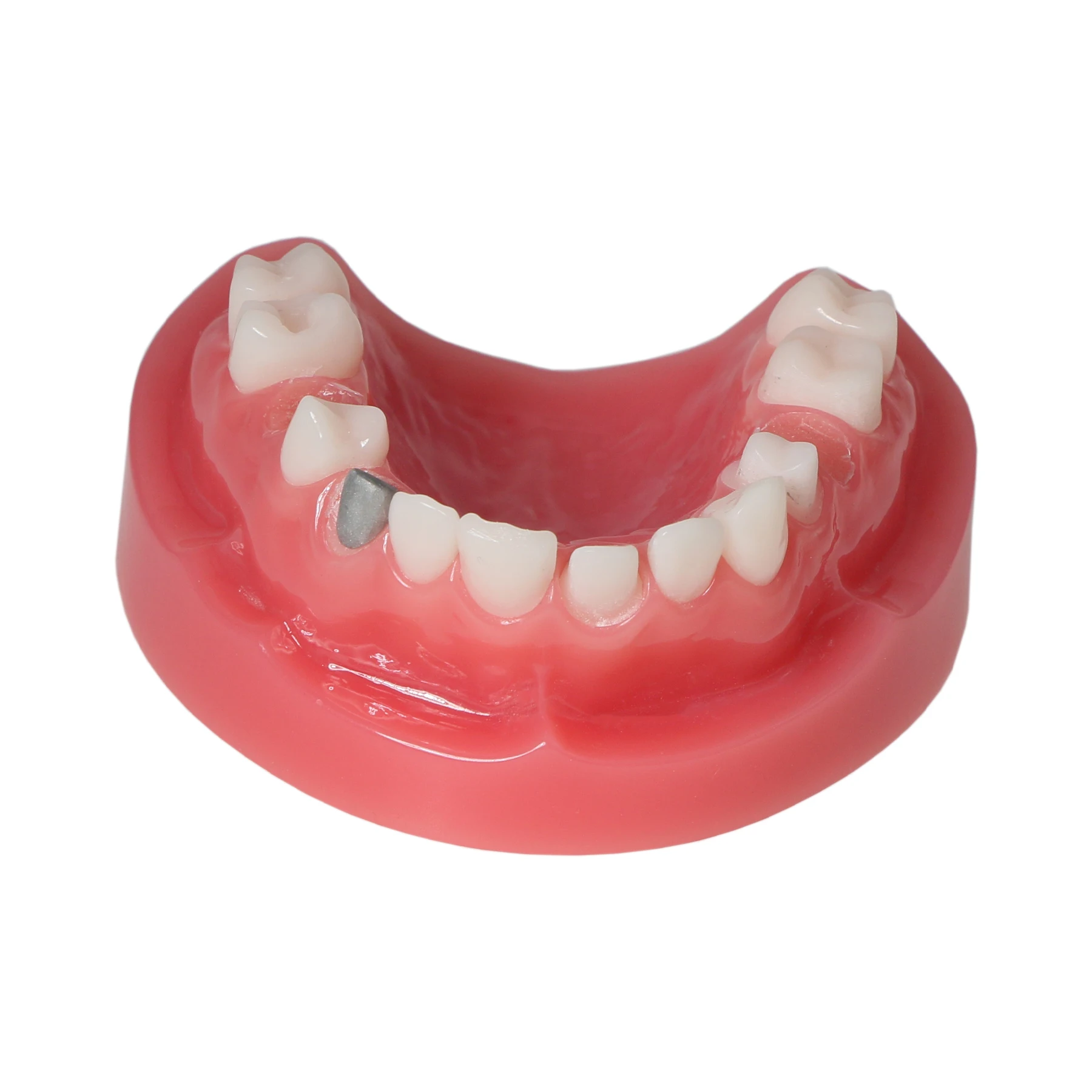 Afbeelding 4: M6024 Dental Post Core Bridge Overdenture Model Implantaatrestauratiemodel