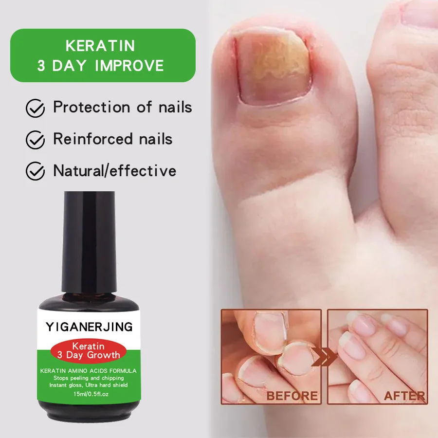 Yiganerjing-fórmula de queratina para uñas, 2 piezas, aminoácidos, elimina la queratina, crecimiento de 3 días, Peeling y Chipping, reparador de uñas, 15ml