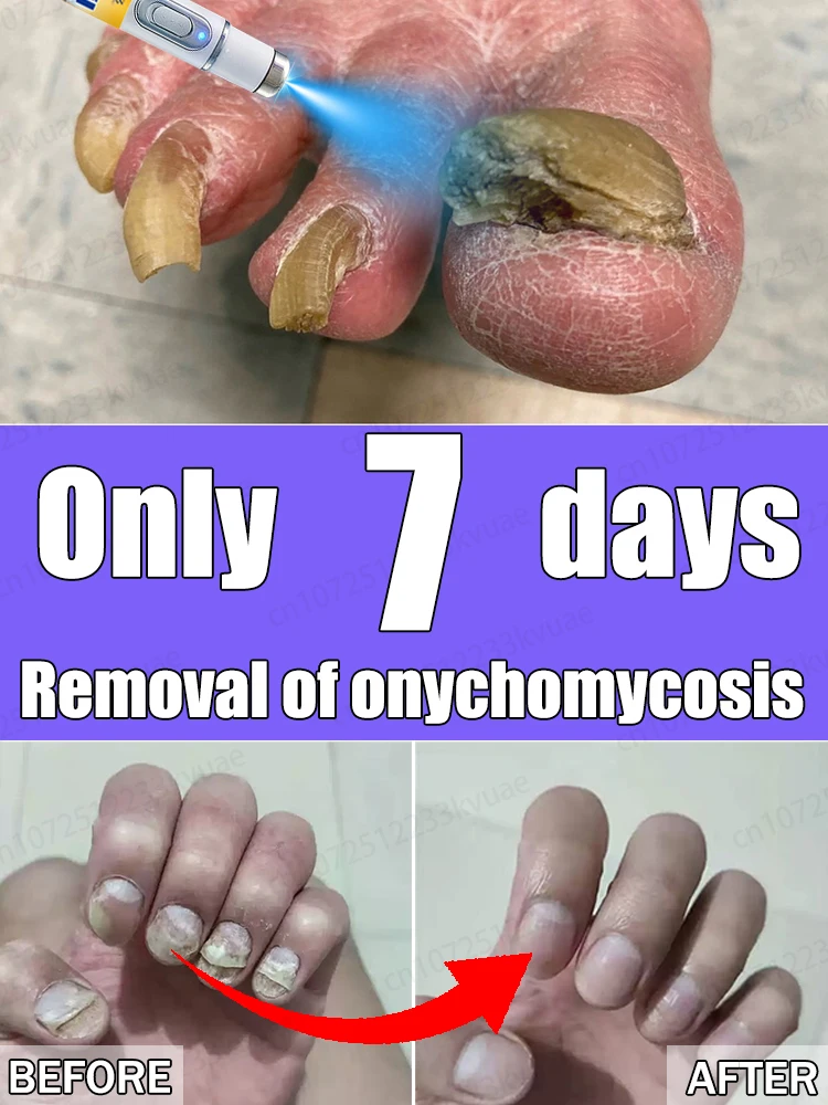 

Say goodbye to onychomycosis with scientific methods